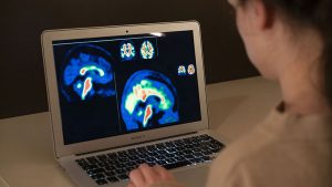 Un estudio impulsado por La Caixa permite avanzar en el diagnóstico del Alzheimer